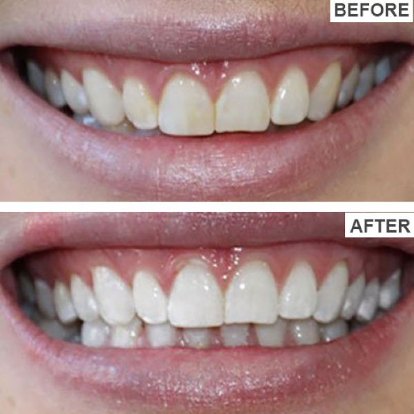 J2OYTEETH